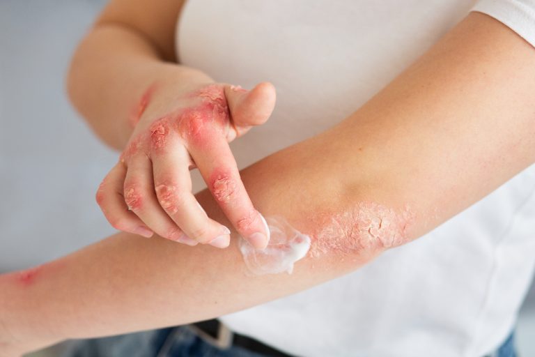 Psoriasis