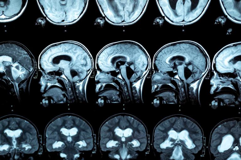 hydrocephalus